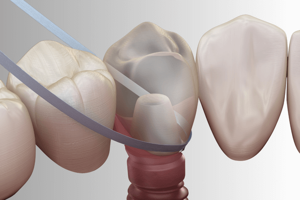 flossing-of-dental-implants