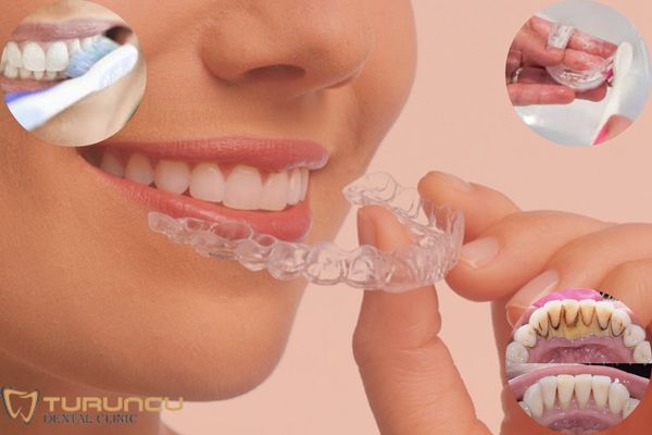 Evde şeffaf diş plağı temizliği nasıl yapılır? Antalya