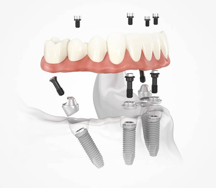 All on Four-All on Six Implant Treatment in Antalya,Turkey 