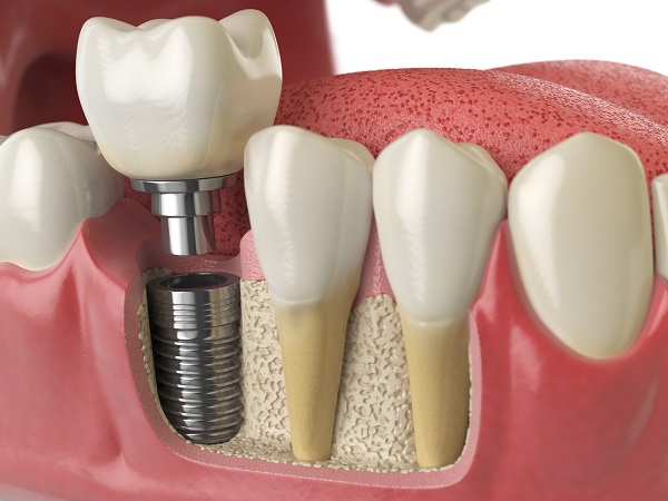 Diş implantı antalya
