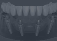 Dental Implants,All on Four,All on Six