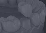 Veneer Teeth-Zirconia Crown-Composite Veneers-Cost