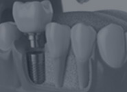 İmplant diş nedir - diş kliniği antalya